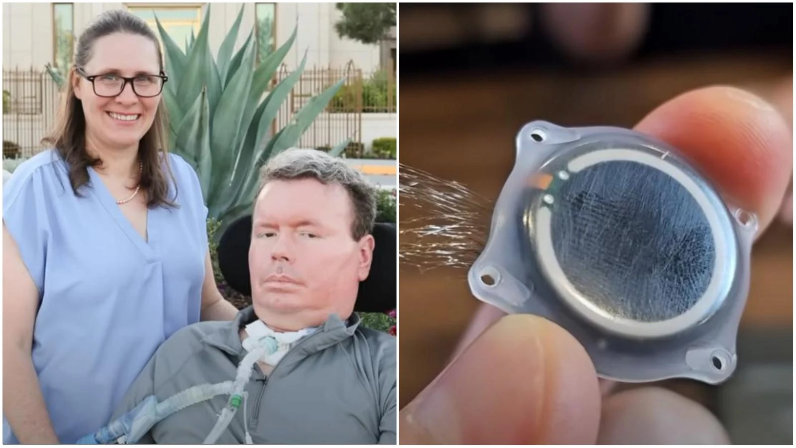 Neuralink, il primo video su YouTube realizzato col pensiero da un malato di Sla