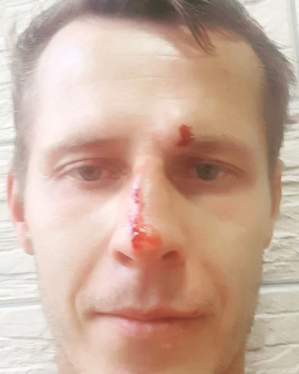 З'явилося фото побитого українського арбітра