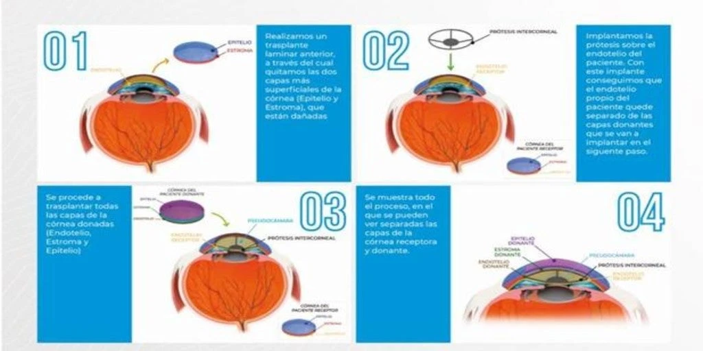 Desarrollan la primera prótesis corneal que se implanta sin necesidad de realizar un trasplante penetrante