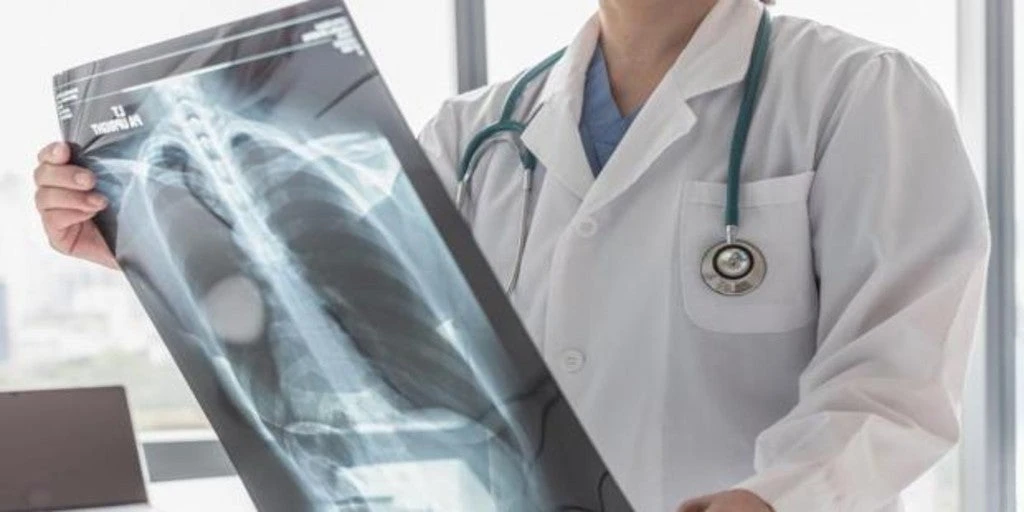 Estos son los síntomas y el perfil del paciente con el cáncer de pulmón más agresivo