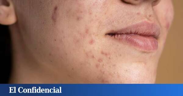 “Funcionaba, pero producía cáncer”: por qué una de las últimas modas contra el acné es un disparate