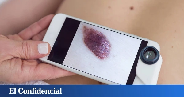 El Hospital público Universitario Rey Juan Carlos consolida su experiencia en cirugía de Mohs