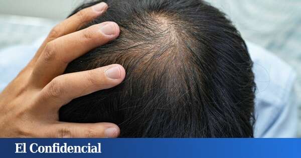 Giro de 180 grados: la ciencia encuentra un tratamiento prometedor para la calvicie