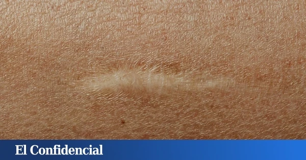 Australia podría haber creado una crema que elimina las cicatrices permanentes de la piel