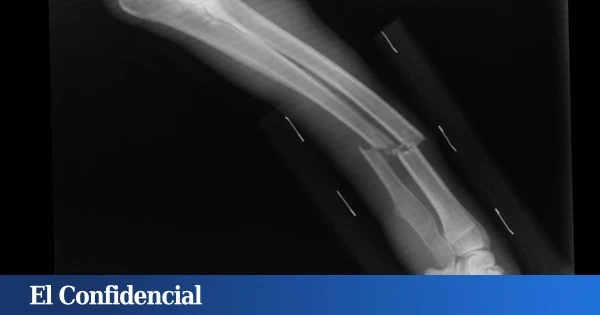 Hay algo en lo más profundo de los huesos que no debería estar ahí. Y puede causar fracturas y deformaciones