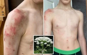 Plant branded most dangerous in UK leaves two boys with scorching red blisters
