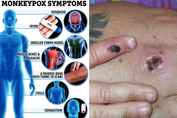 Brits given monkeypox vaccine to stop spread after two confirmed cases
