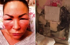 Beautician looked like 'acid attack victim' after mould took over her flat