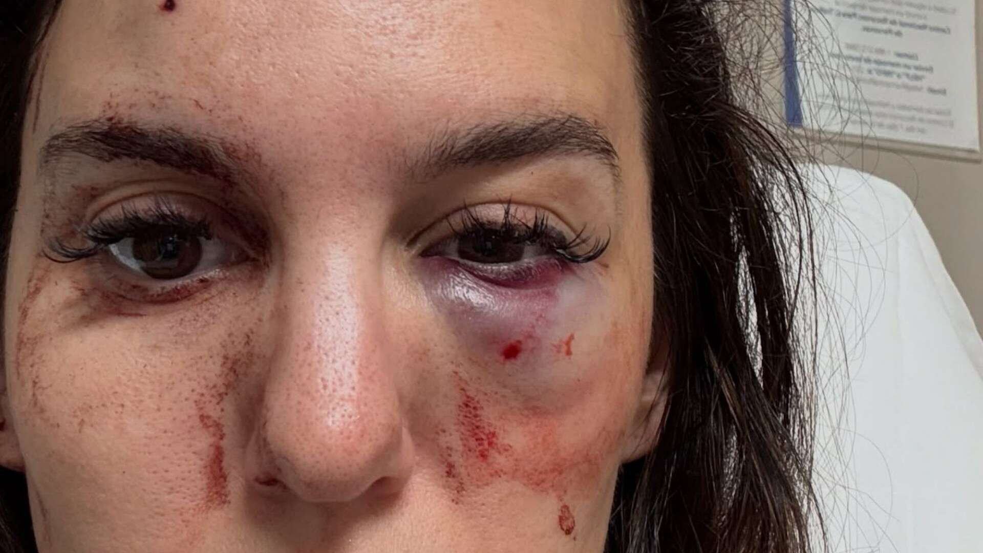 Disney star reveals horrific eye injury after getting shot saying she almost went BLIND and has lead stuck in her skull