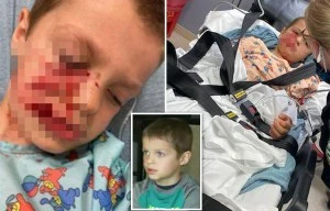 Boy, 5, suffers horror wounds after being mauled in face by babysitter's dog
