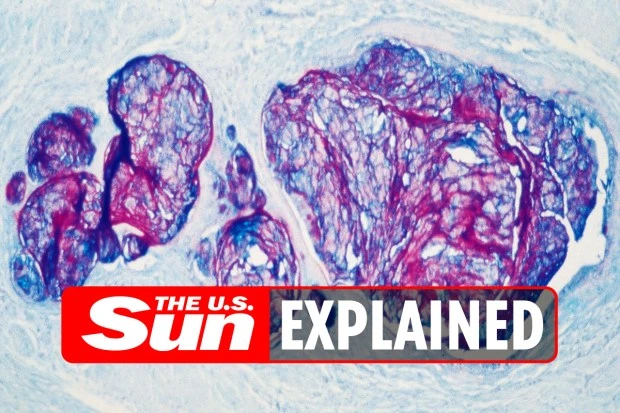 What to know about adenocarcinoma