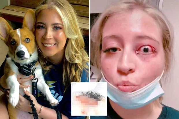 Girl whose eyelid was ripped off by chihuahua blasts lash tech for ghosting her