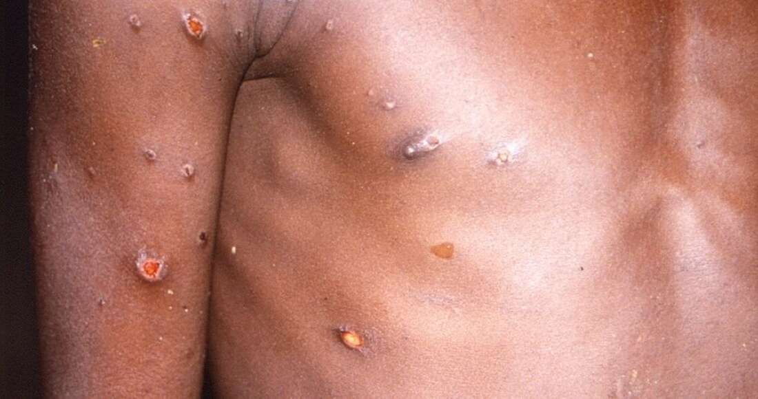 Salud emite aviso epidemiológico tras alerta internacional por contagios de mpox