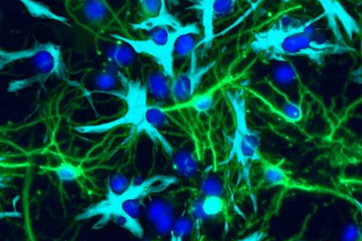 Inhibir un mensajero químico neuronal podría frenar el tumor cerebral infantil más común