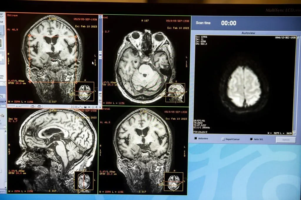 El Plan Español del Cerebro afrontará los trastornos cerebrales que sufrirá uno de cada dos españoles