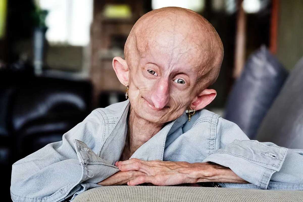 Muere a los 19 años Beandri Booysen, la influencer de TikTok sudafricana enferma de progeria