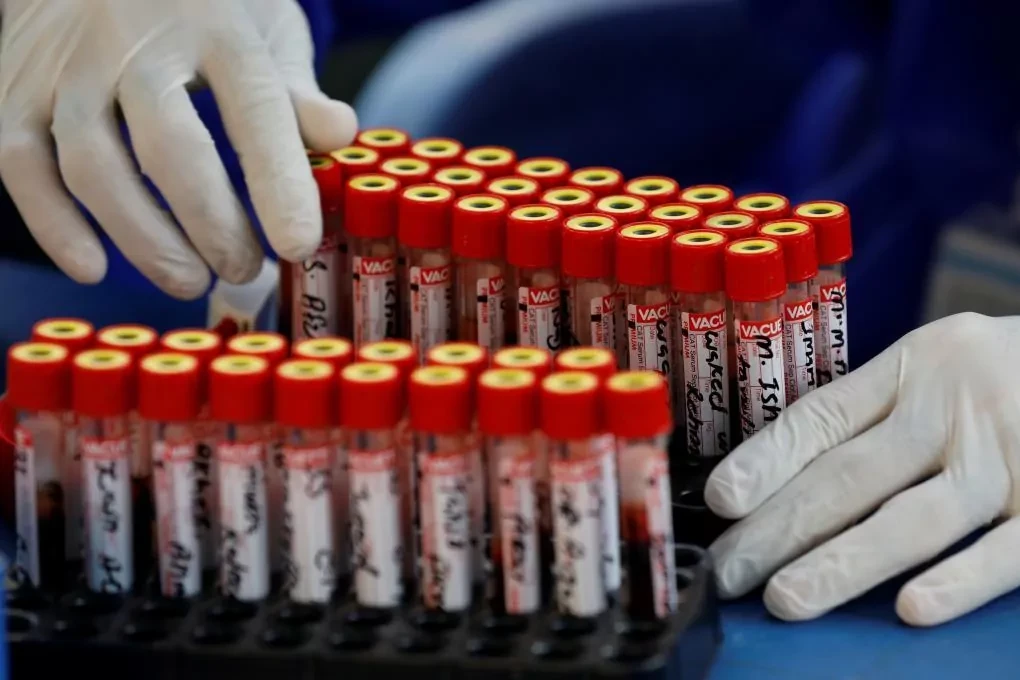 Un estudio espaol sugiere que la conjuntivitis podra ser el primer sntoma de deteccin del Covid-19