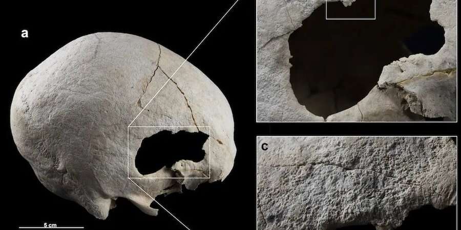 В Іспанії знайшли скелет жінки, яка 4500 років тому пережила дві трепанації черепа