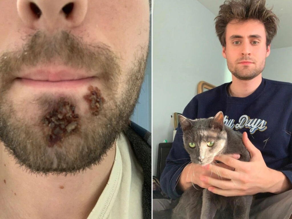 Horror result of using roommate’s razor