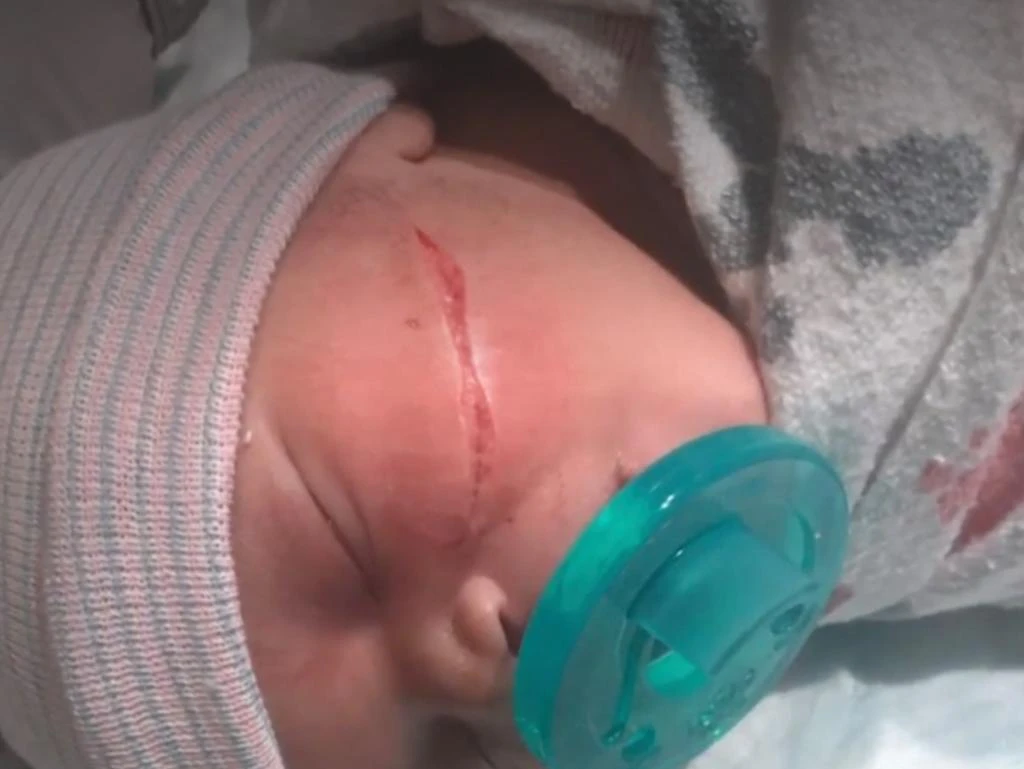 Newborn’s face slashed in C-section