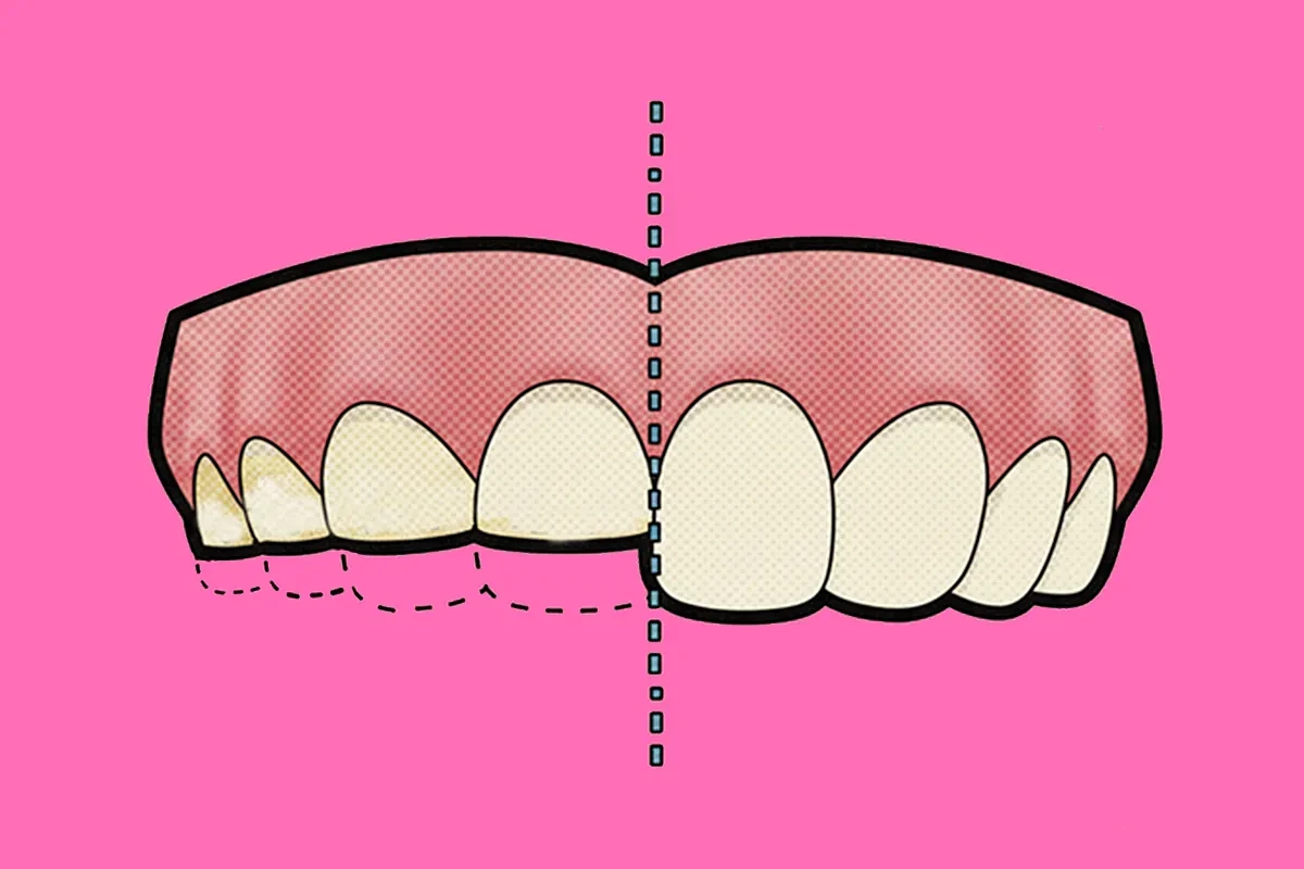 Bruxismo: así se reflejan el estrés y la ansiedad en tus dientes