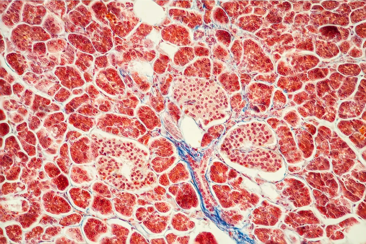 Así es el revolucionario fármaco para cáncer de páncreas que ya empieza a beneficiar al enfermo