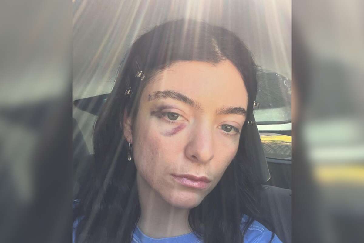 Lorde fans express concern after singer shares selfie with black eye