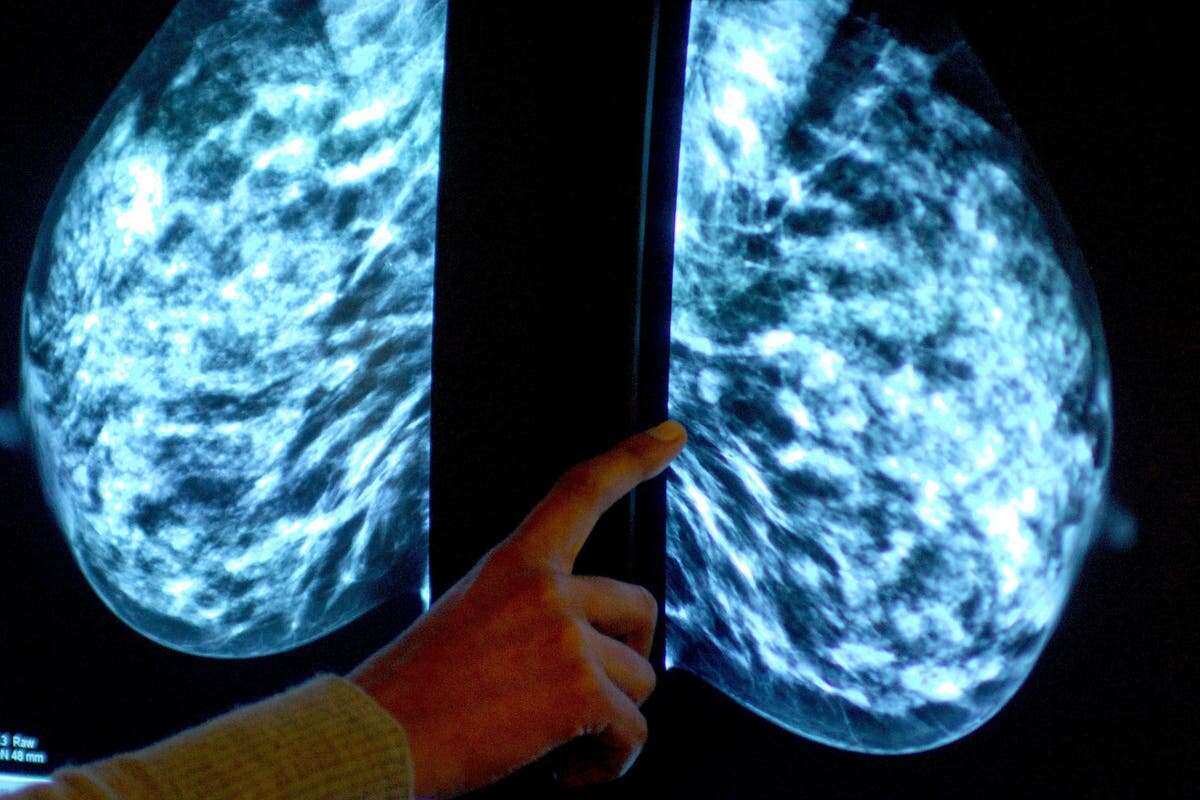 Immune cell discovery ‘could lead to personalised treatment for breast cancer’