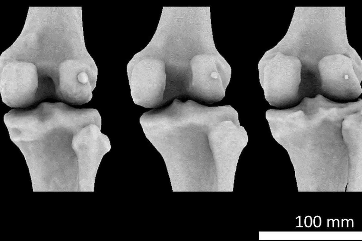 Tiny knee bone linked to osteoarthritis ‘may have helped humans walk upright’