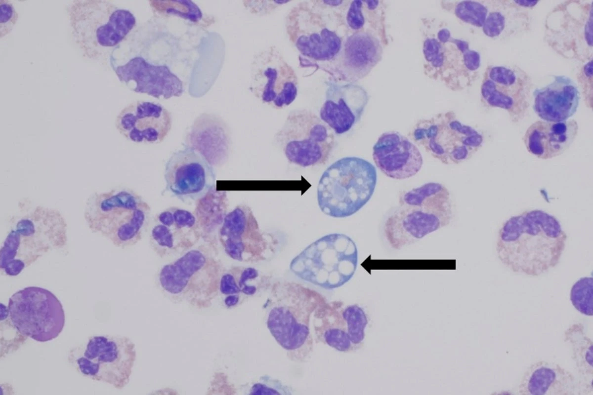 A woman got a fatal brain-eating ameba after rinsing her sinuses.