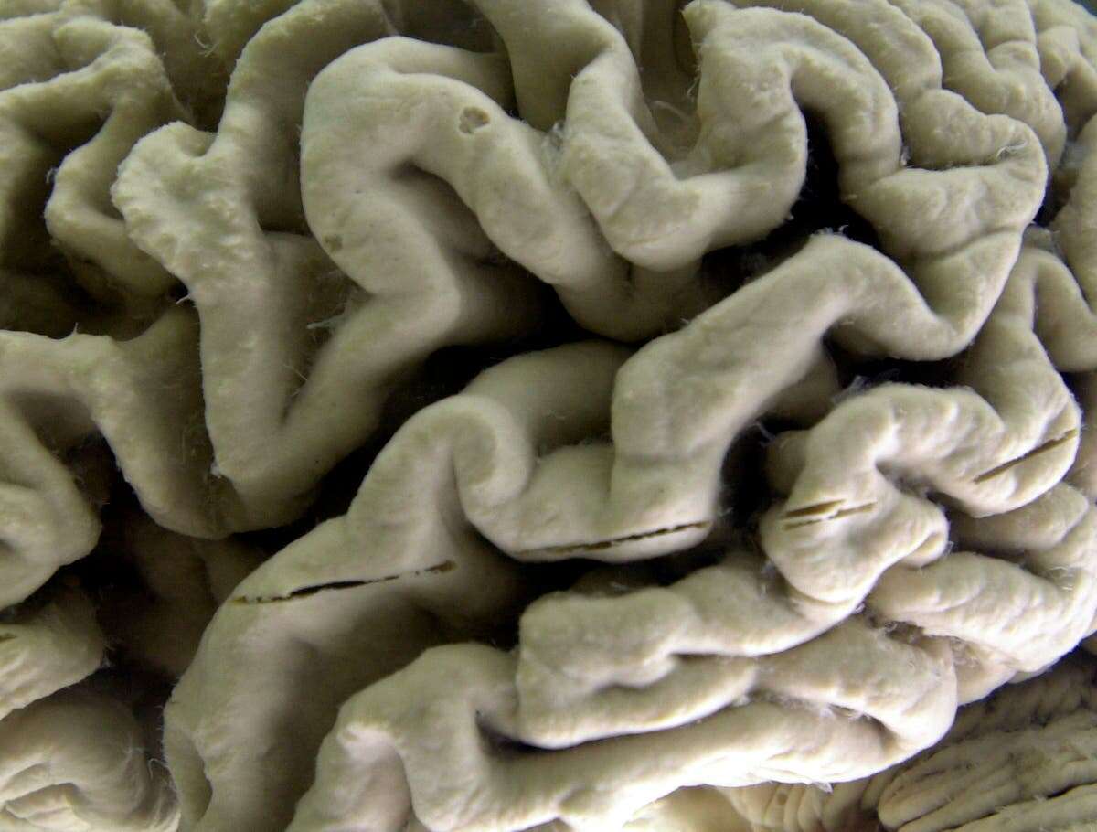 Teenager’s ‘probable’ Alzheimer’s diagnosis baffles scientists