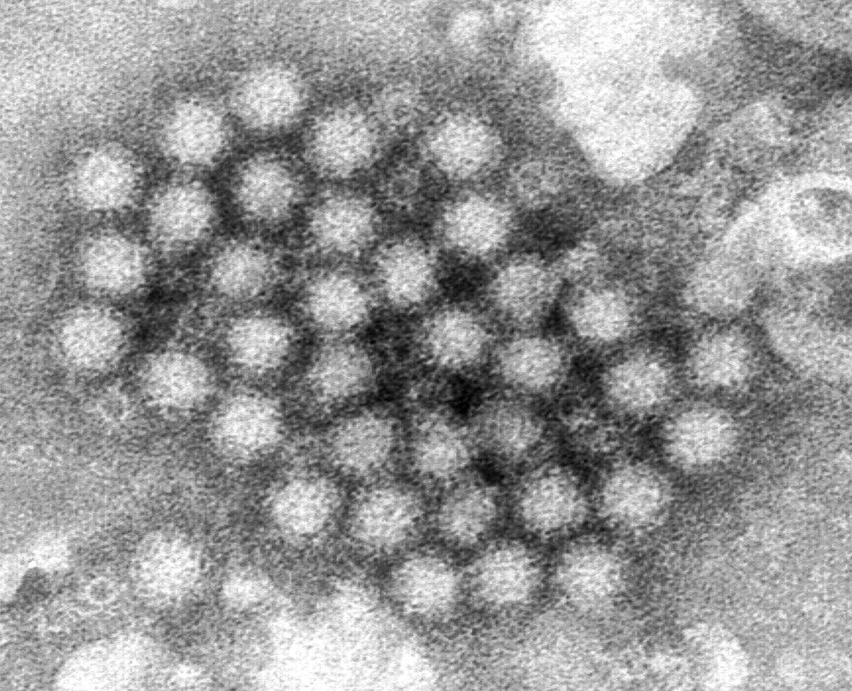 Norovirus is back in full force as cases surge in US