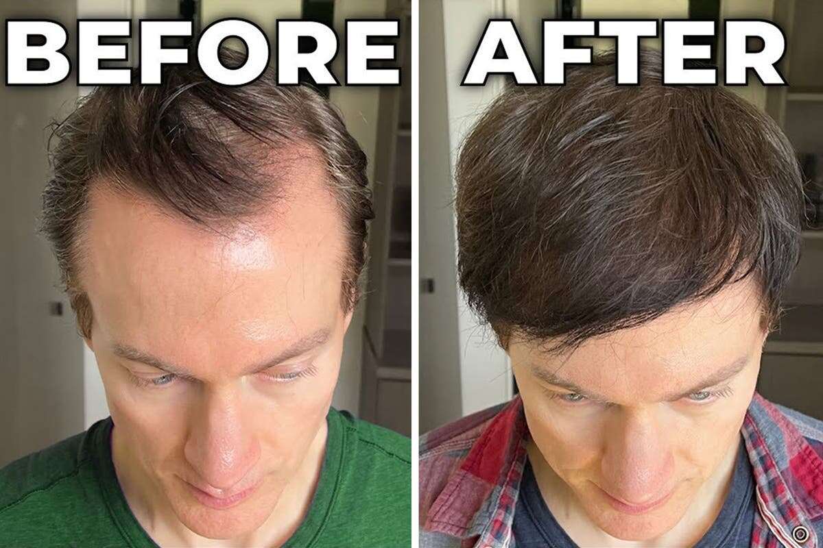 Biohacker, 47, reveals how he managed to reverse his hair loss