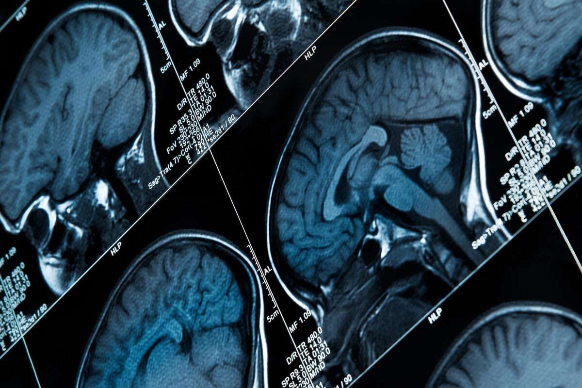 How AI could help detect epilepsy before radiologists