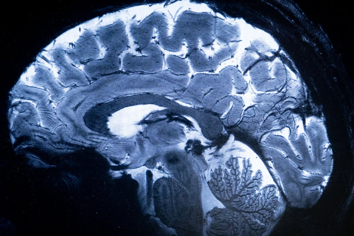 Groundbreaking study finds Alzheimer’s could be due to this deficiency