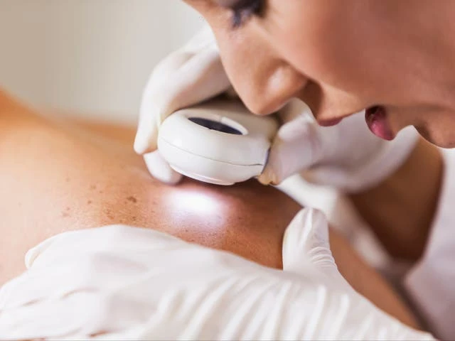Rates of skin cancer type in UK men j’umps by nearly half in decade’