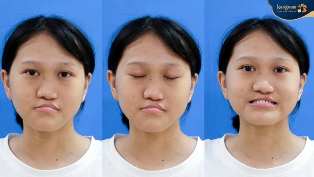 14 tiếng phẫu thuật, 3 tháng đeo 