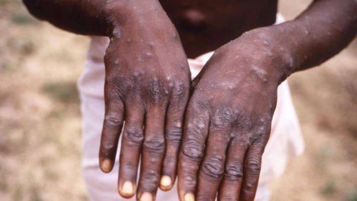 Osun confirms two cases of monkey pox