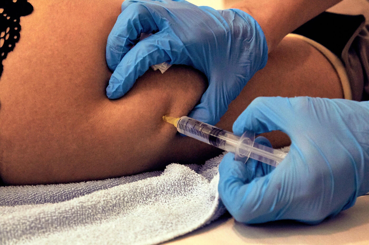 Des publicités vantant la chirurgie du « Brazilian Butt Lift » interdites au Royaume-Uni