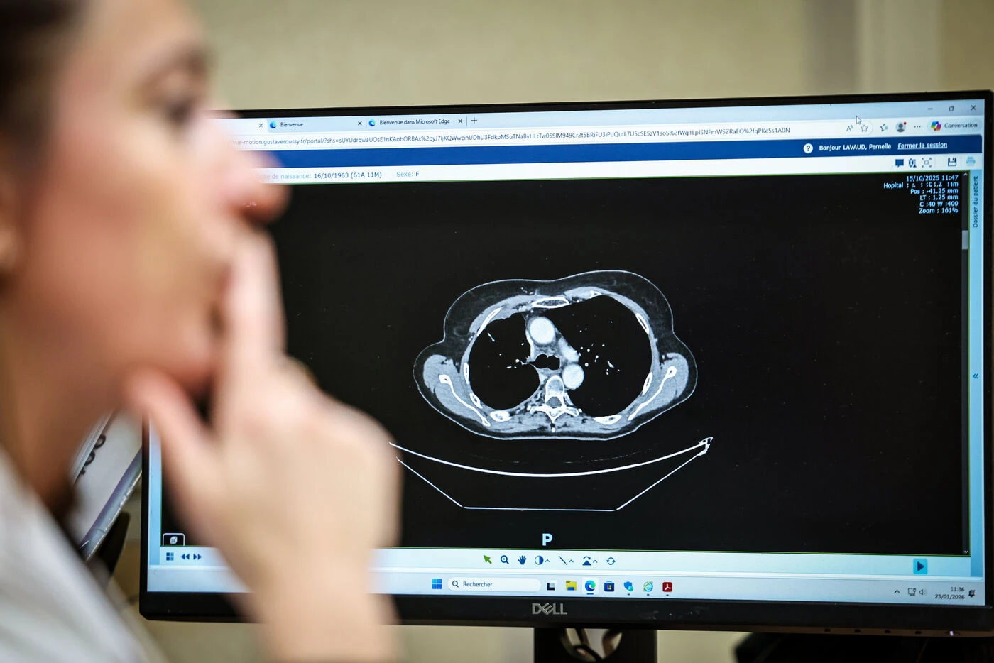 Dépistage du cancer du poumon après 50 ans, c’est parti : voici comment participer