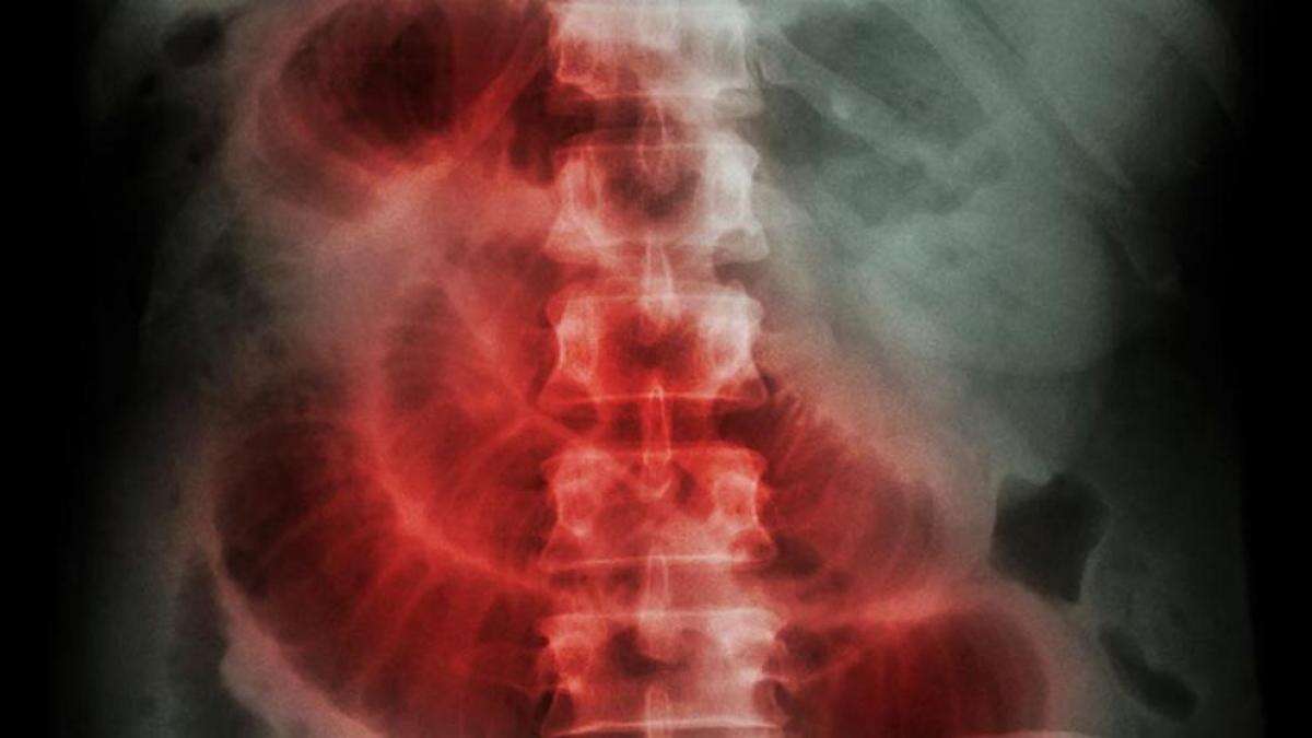 Obstrucción intestinal, síntomas y causas que no puedes ignorar