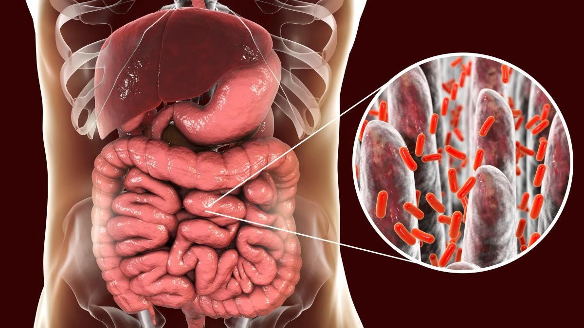 El sobrecrecimiento bacteriano del intestino delgado, una dolencia al alza