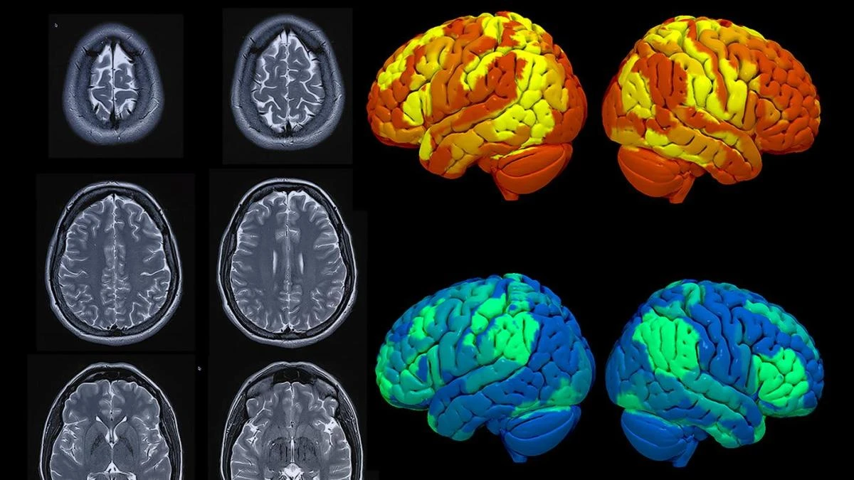 Sanitas CIMA, a la vanguardia en neurología con tecnología avanzada y tratamientos