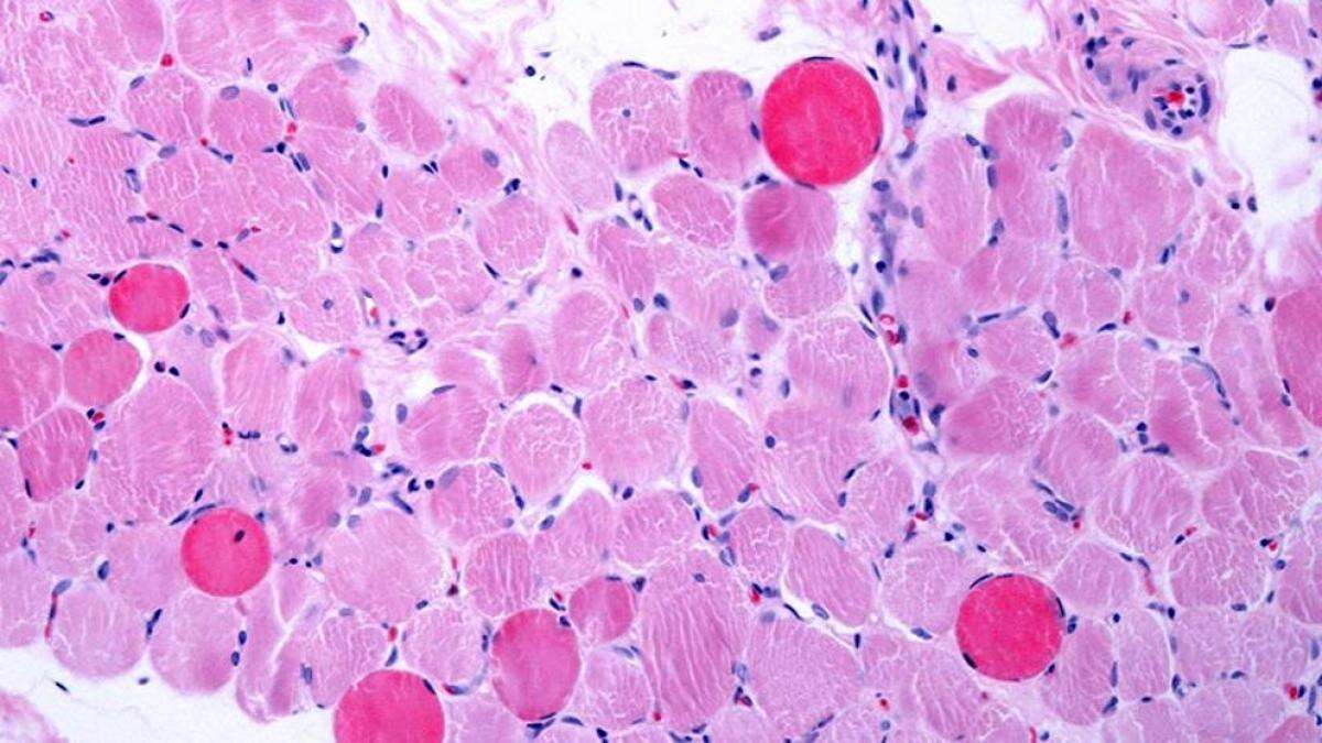 Distrofia muscular de Duchenne: conoce los tratamientos disponibles