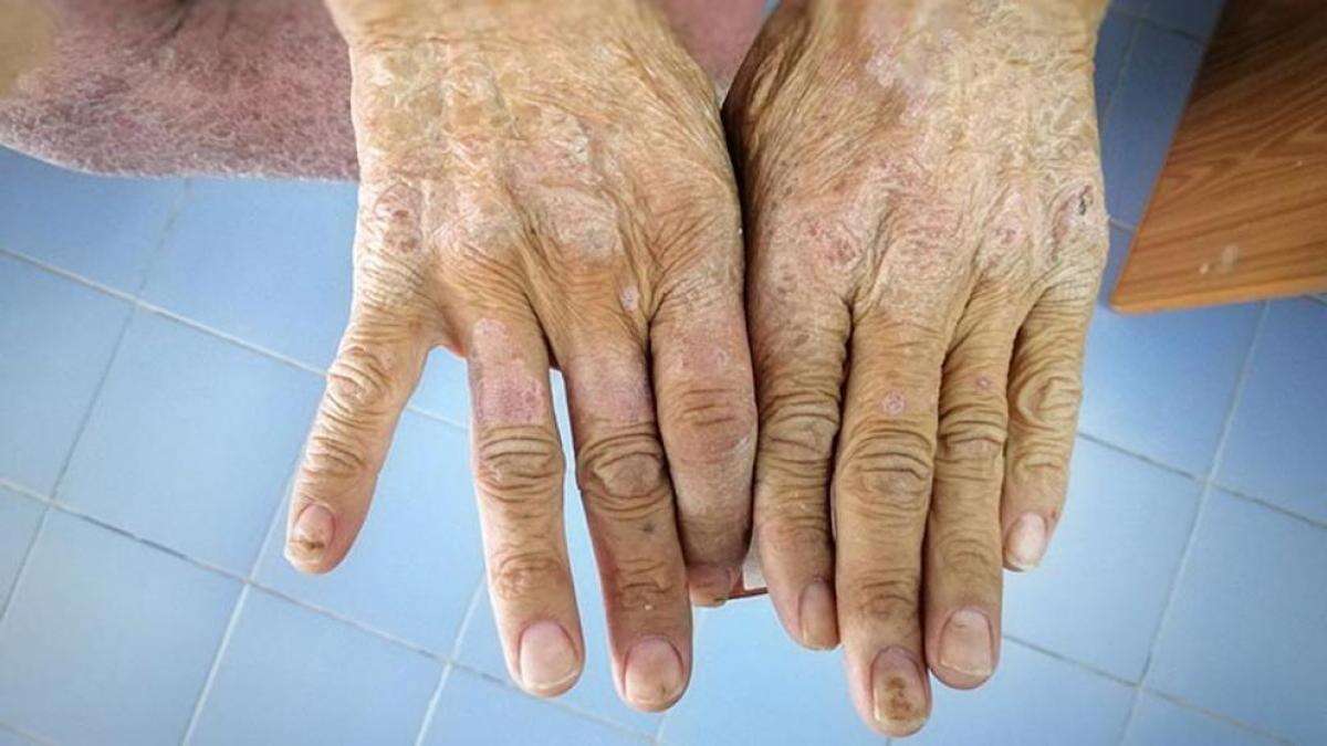 Esclerodermia: síntomas, causas y cómo tratar esta enfermedad autoinmune