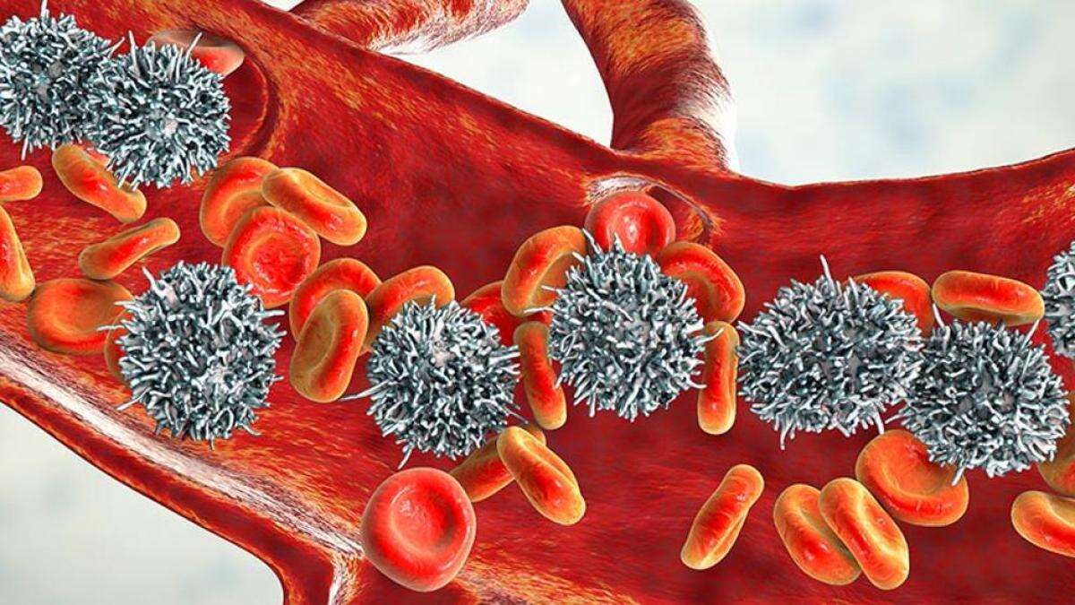 Leucemia crónica: qué es, síntomas y tratamientos recomendados