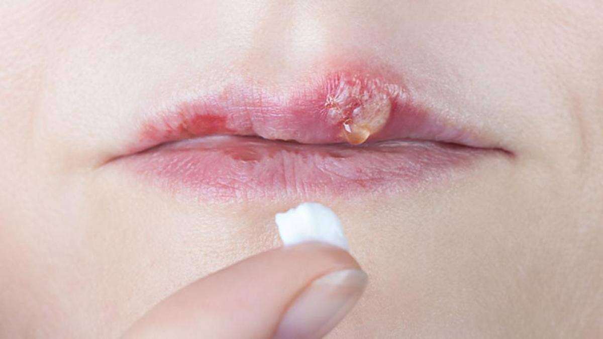 Herpes labial, cómo reconocerlo y tratarlo