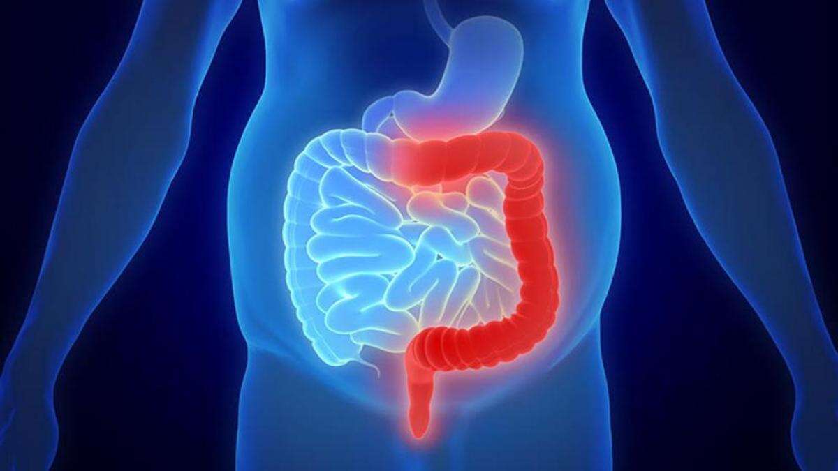 Colitis ulcerosa: qué es y cómo tratar esta enfermedad inflamatoria