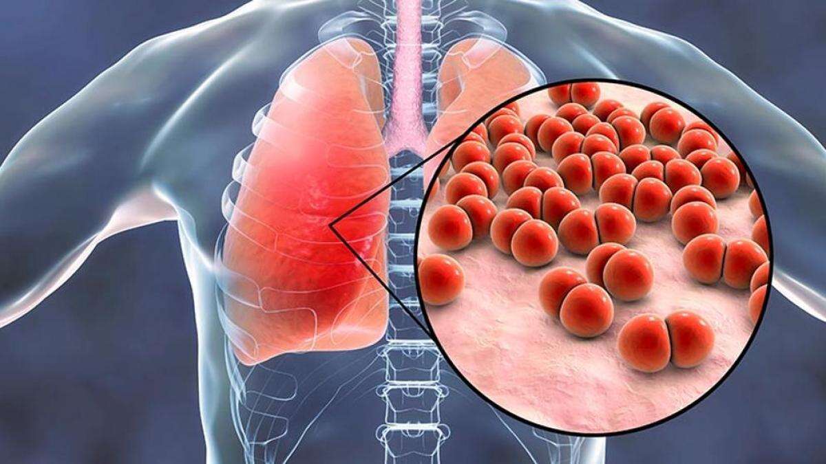 Neumonía: qué es, síntomas y cómo tratar esta infección pulmonar