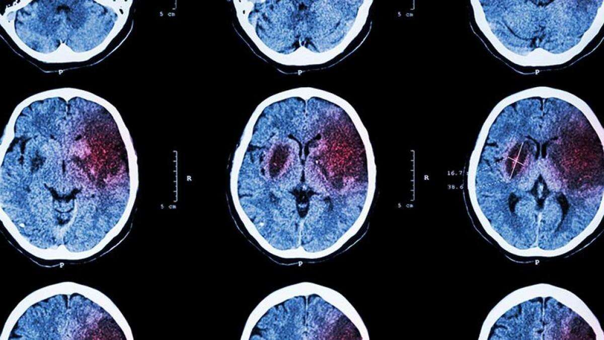 Cómo actuar ante un accidente cerebrovascular: síntomas y tratamientos